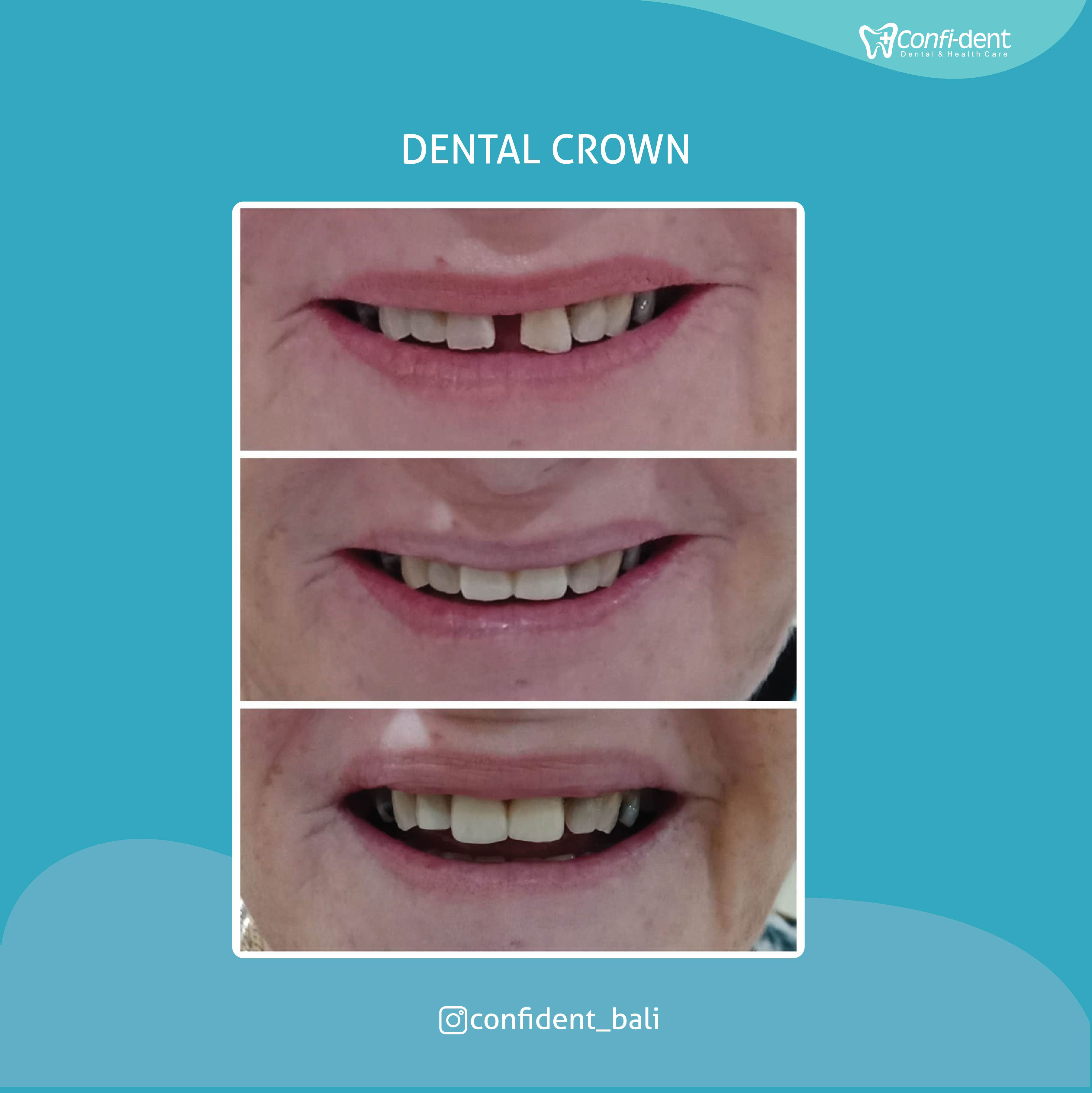 Confident Bali Dental Clinic Best Dentist in Bali
